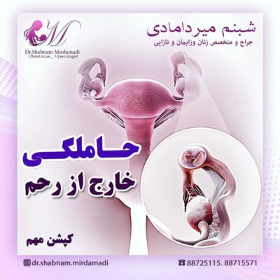 حاملگی خارج از رحم